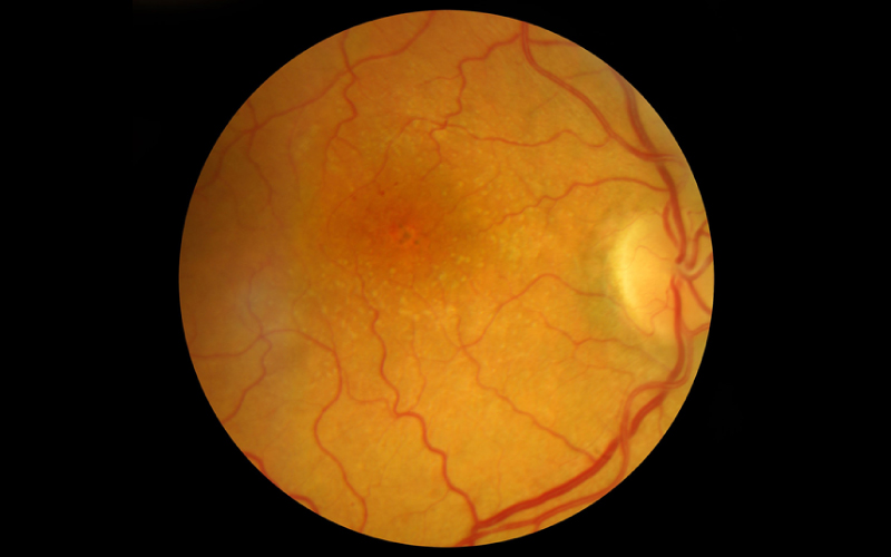 Age-Related Macular Degeneration (AMD)