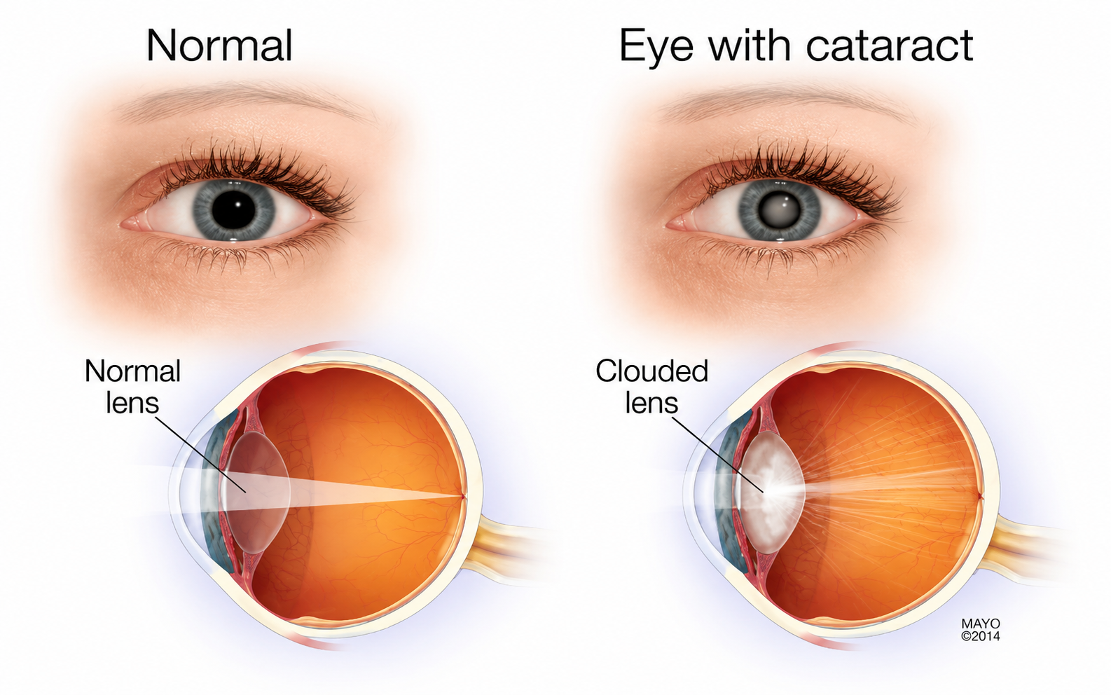 Cataracts