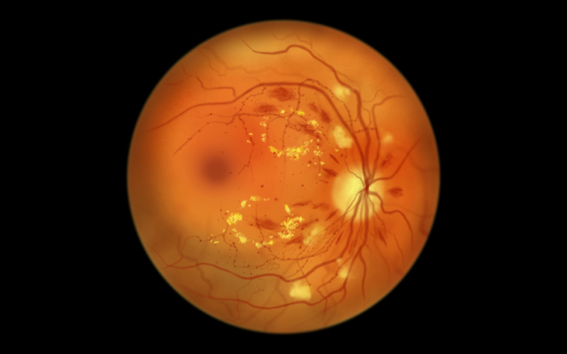 Diabetic Retinopathy (DR): TCM Ophthalmic Insights on Syndrome Differentiation and Conditioning Strategies