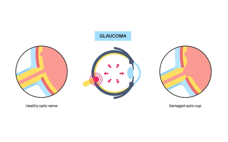 Glaucoma