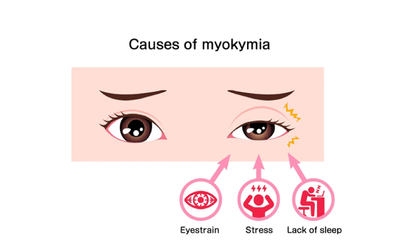 TCM Secrets to Calming Twitching Eyelids (Myokymia)