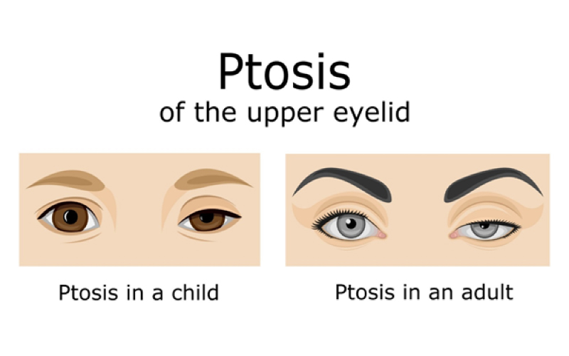 Understanding Ptosis (Droopy Eyelids): Causes, Symptoms, and TCM Remedies