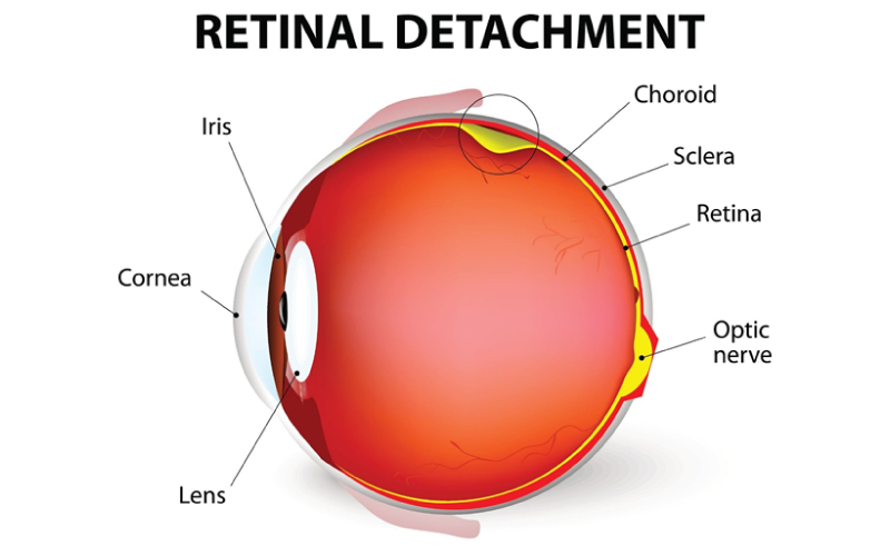 TCM Ophthalmic Insights on Syndrome Differentiation and Conditioning Strategies for Retinal Detachment